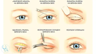 Блефаропластика - Медицинский Центр \"Седьмое Небо\"