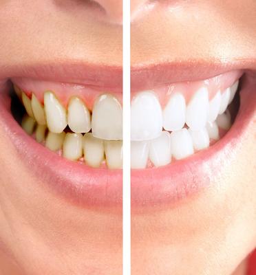 Художественная и эстетическая реставрация, восстановление и наращивание  зубов