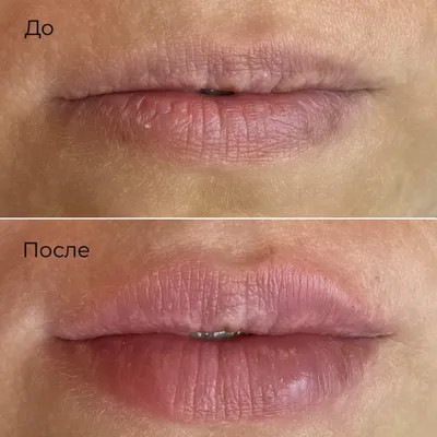 Увеличение губ препаратом Hyafilia Classic Plus 1.0 - «Мои попытки  исправить природную мышечную асимметрию губ. Техника «плоский бантик». Фото  до, после, спустя месяц» | отзывы