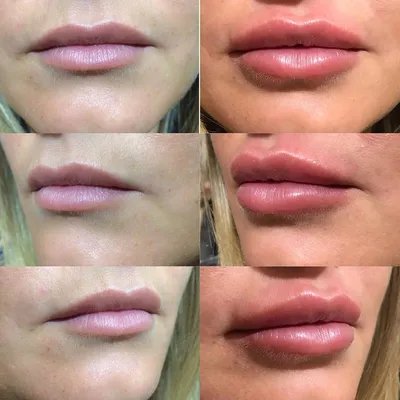 Контурная пластика губ гиалуроновой кислотой: цены в Москве | Коррекция  контура губ в клинике BeautyWay Clinic