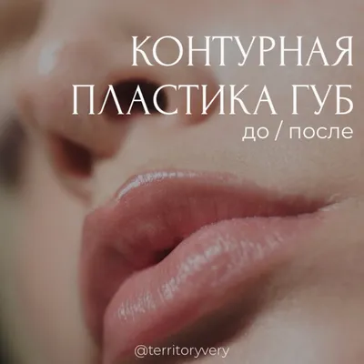 Французские [парижские] губы — часто используемая техника увеличения губ,  помогающая получить нужный объем при максимально естественном… | Instagram