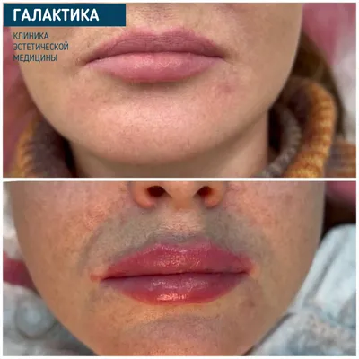 Красивые губы. Увеличение губ до и после. | Клиника ГАЛАКТИКА | Дзен