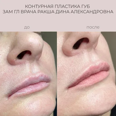 Контурная пластика губ в Москве в Versua Clinic, цены на увеличение губ,  отзывы