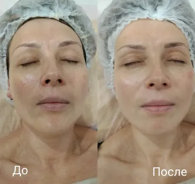 Испанский массаж лица фото до и после