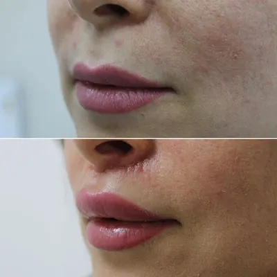 До и после хейлопластики у доктора Вакориной Е.И. Последствия неудачной  операции по увеличению губ. - YouTube