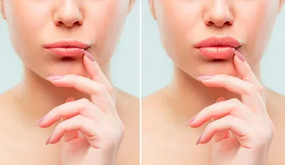 Хейлопластика губ - отзывы, до и после, противопоказания | expertcosmo.ru