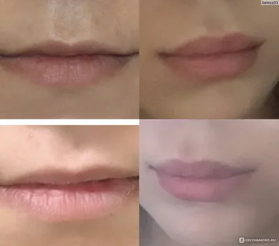 Пластика губ (фото до и после) – Исамутдинова Г. М.