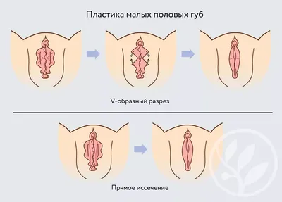 Интимная пластика в медицинском центре «Номосклиник» в Москве