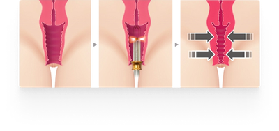 Лабиопластика филлерами 🌷 ⠀ Сделать интимную зону привлекательной и  чувственной помогут инъекции филлеров. В \"Медиал\" процедуру проводит… |  Instagram