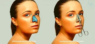 Ринопластика в Минске: цены на пластику носа. Фото до и после