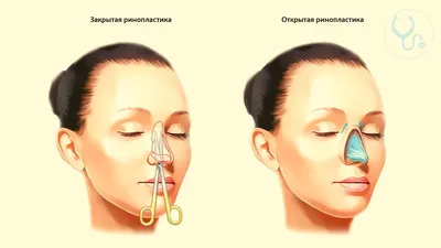 Пластика носа (ринопластика): стоит ли делать? - Клиника в Уручье