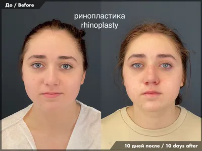 Ринопластика фото до и после Минск фотографии