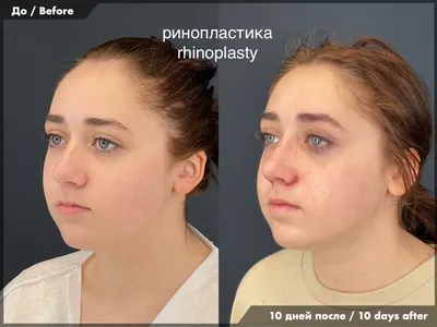 Ринопластика - Сделать пластику носа в Минске по выгодной цене