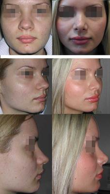Коррекция горбинки носа в Новосибирске - цена, отзывы, фото до и после |  клиника UMC.