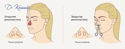 Улучшение формы носа (ринопластика) | Медицинский центр Эра