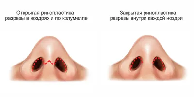 Безоперационная ринопластика👃🏻 Нос можно скорректировать без операции, с  помощью инъекций! 💉Процедура выполняется филлером гиалуроновой… | Instagram