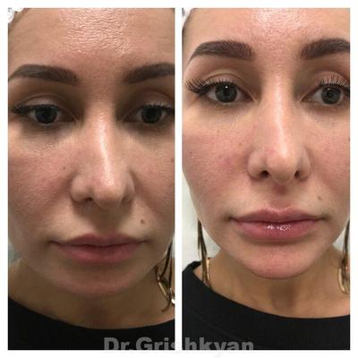 https://www.instagram.com/dr.tkachenko_k_rhinoplasty/p/C34VEcoPT-T/