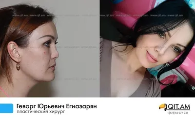 Ринопластика кончика носа в VIP Clinic в Москве