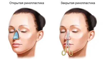 Ринопластика: цена в Москве. Коррекция носа в VIP Cliniс