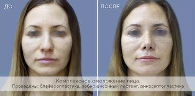 Ринопластика носа в Москве - цена в клинике доктора Сойфера