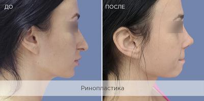 Ринопластика в Москве, цены на пластику носа | Dr. Shihirman