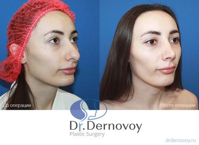 Фото до и после ринопластики кончика носа | пластический хирург Аганесов  Г.А., Москва
