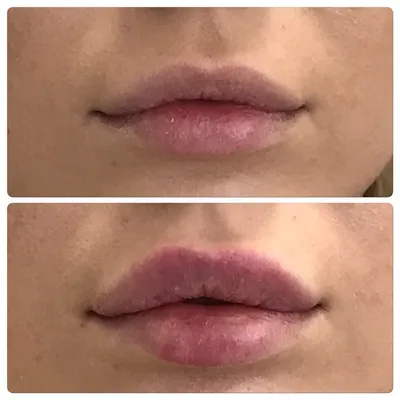 увеличение губ фото до и после | filler.by