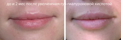 Увеличение губ гиалуроновой кислотой в Минске цена evos.by