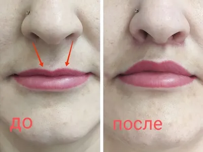 УВЕЛИЧЕНИЕ ГУБ 👄| БОТОКС МИНСК ВРАЧ-КОСМЕТОЛОГ (@dr.olgaprigorni) •  Instagram photos and videos