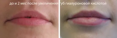 Увеличение губ ювидерм и коррекция носогубных складок гиалуроновой  кислотой, сколько стоит увеличение губ, цена увеличения губ в Москве