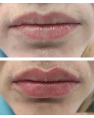 Фото до и после увеличения губ филлерами