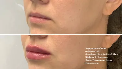 Увеличение губ в Минске, цены в косметологии KODERM