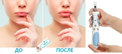 Увеличение губ гиалуроновой кислотой в Минске - Цены на коррекцию губ  филлерами