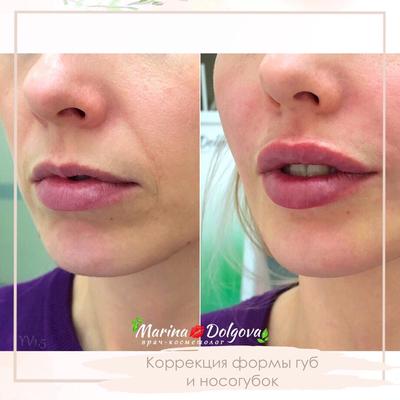 Увеличение губ гиалуроновой кислотой в Новосибирске | Цена, отзывы, фото до  и после в клинике Би Лучче