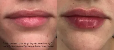 Увеличение губ в Новосибирске от косметолога Марины Долговой