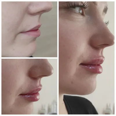 Увеличение губ, до и после 💕 | Instagram