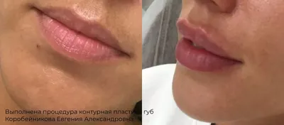Легендарная пластика губ в Новосибирске