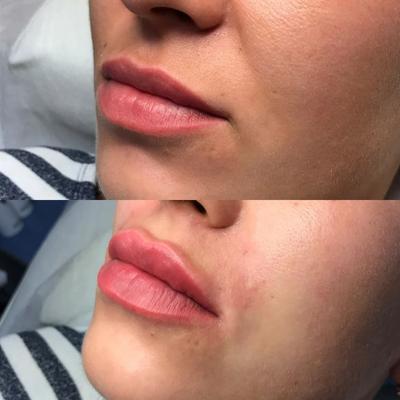 Губы лопнули, гель потек»: косметолог изуродовал блогершу инъекциями  красоты - KP.RU