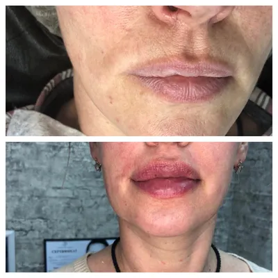 Увеличение губ и коррекция формы губ в Новосибирске | Клиника косметологии  GEN87 | Цены, фото до и после, видео смотрите на сайте
