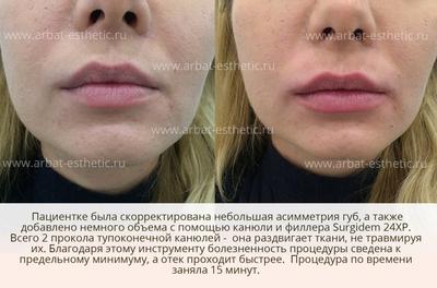 Увеличение губ в Новосибирске - цены на гиалуроновую кислоту и ботокс для  губ от 8500 руб.