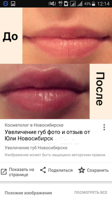 Чем мазать губы после увеличения гиалуроновой кислотой – послепроцедурный  уход | «Сибирская»